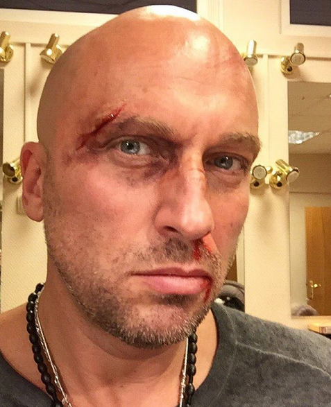 Дмитрий Нагиев побитое лицо